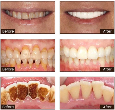 Niacinamide Whitening Toothpaste - Whiter Teeth, Fresh Breath