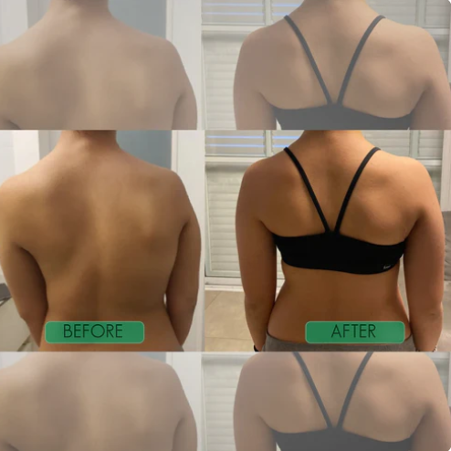 Posture Perfect Shoulder Brace™