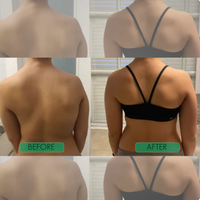 Posture Perfect Shoulder Brace™