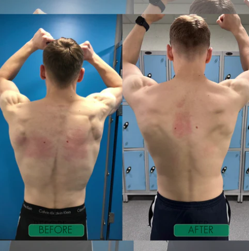 Posture Perfect Shoulder Brace™