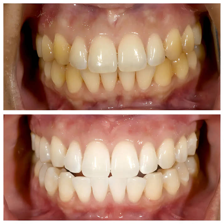 Niacinamide Whitening Toothpaste - Whiter Teeth, Fresh Breath