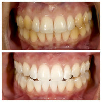 Niacinamide Whitening Toothpaste - Whiter Teeth, Fresh Breath