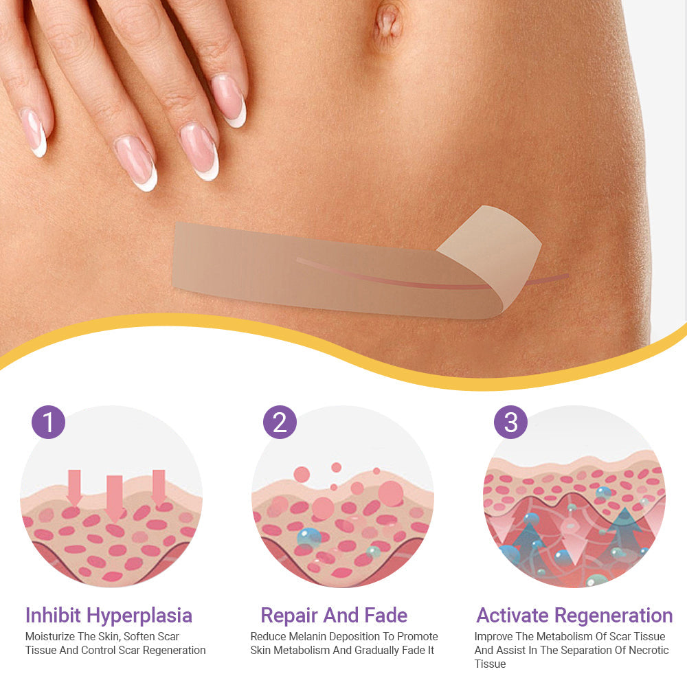ScarSilk™ Silicone Scar Reduction Strips™