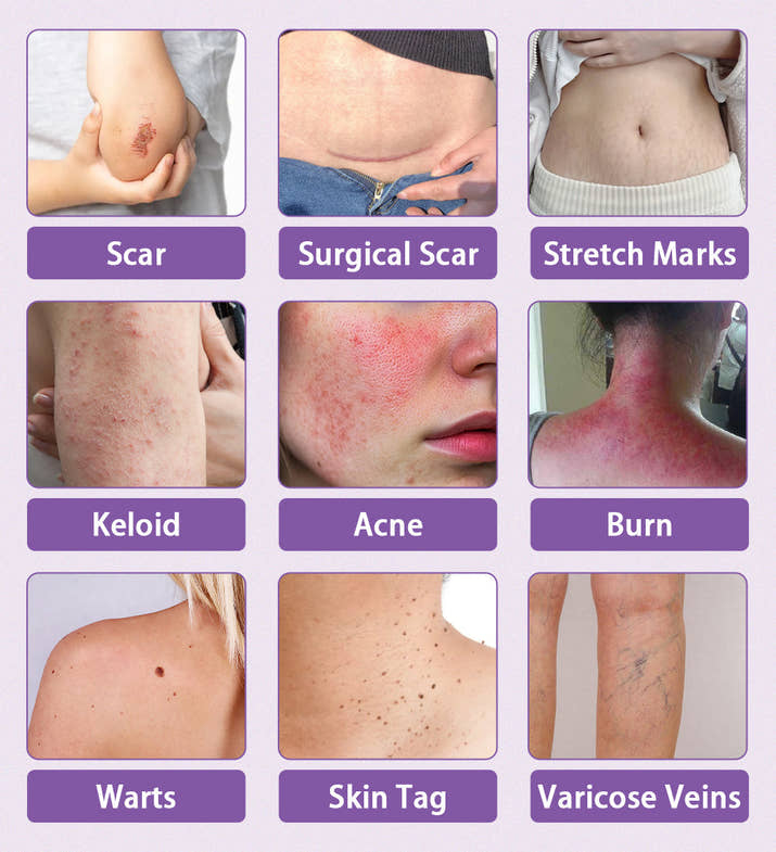 ScarSilk™ Silicone Scar Reduction Strips™